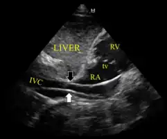 The device inappropriately passing into the inferior vena cava