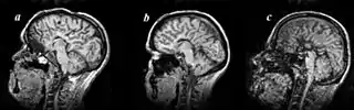 Agenesis of the corpus callosum