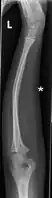 Side view of bowing fractured radius and ulna