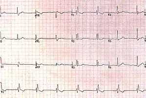RBBB