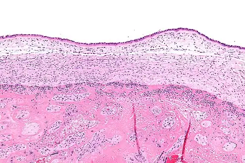 Intermediate magnification micrograph of moderate chorioamnionitis.