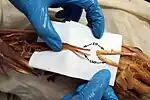 Extensor indicis proprius (EIP) and extensor medii proprius (EMP)