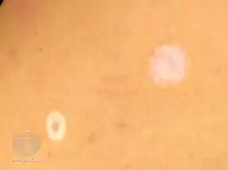 Halo mole