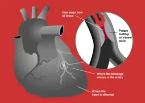 Heart attack