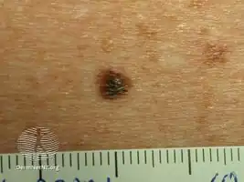 Lentigo simplex