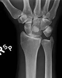 Dislocated lunate