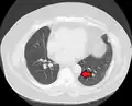 Mediastinal lipomatosis