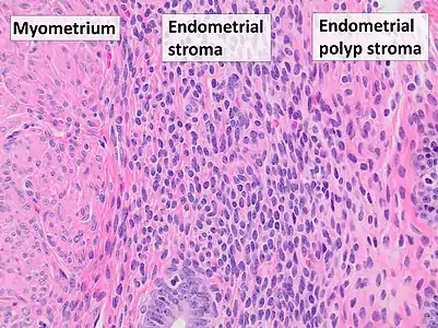 Myometrium (smooth muscle cells) versus endometrial stroma (more cellular) versus endometrial polyp stroma (more collagenous). H&E stain