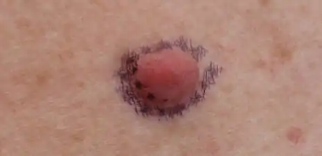 Neurofibroma marked for biopsy, right upper back