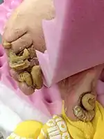 Onychogryphosis