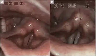 Laryngopharyngeal reflux