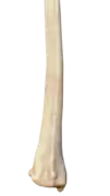 Posterior view of right distal radius