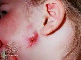 Scrofuloderma