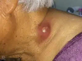 Scrofuloderma