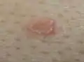Sebaceous hyperplasia with surrounding chronic folliculitis, right mid chest