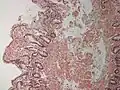 Duodenum with amyloid deposition in lamina propria