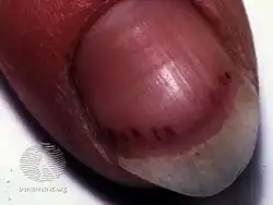 Splinter hemorrhage