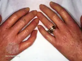 Systemic scleroderma