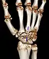 Carpal boss in der Computertomographie: VR-3D-Rekonstruktion. Pseudarthrotische Verbindung der Knochenvorsprünge am Os metacarpale 3 und am Os trapezoideum.