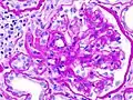 diabetische Nephropathie