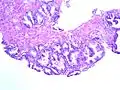 Normales Prostatagewebe in einer Stanzbiopsie. HE-Schnitt