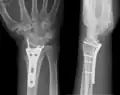 Postoperatives Röntgenbild nach Versorgung eines handgelenknahen Speichenbruchs mit einer mit Schrauben fixierten Platten-Osteosynthese aus Titan, gebräuchlichstes Modell