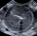 Vollständig von einem Lymphom infiltrierte Darmwand. Die normale Schichtung ist vollständig verschwunden.