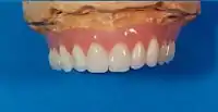 Oberkiefer-Hybridprothese auf dem Arbeitsmodell von vestibulär gesehen.