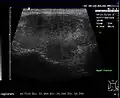 Subakute Thyreoiditis im Ultraschall: diffuse Echoarmut.