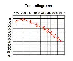 Tonaudiogramm, Schallempfindungsstörung