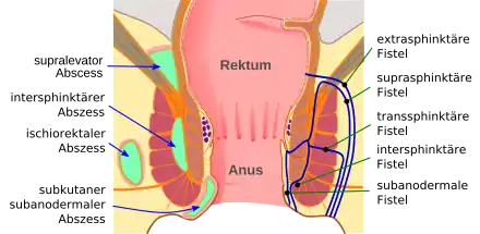 Grafische Darstellung der unterschiedlichen Analabszess- (links) und Analfisteltypen (rechts)